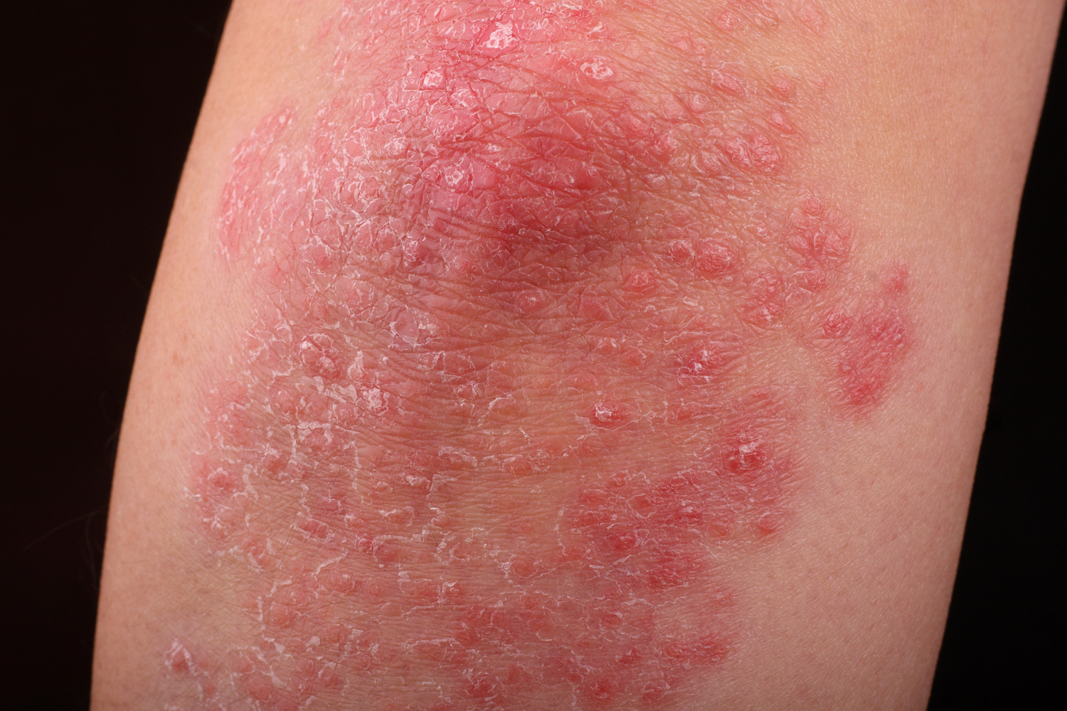 6 Health Conditions Linked to Psoriasis